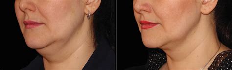 coolsculpting chin brisbane|CoolSculpting Body Sculpting .